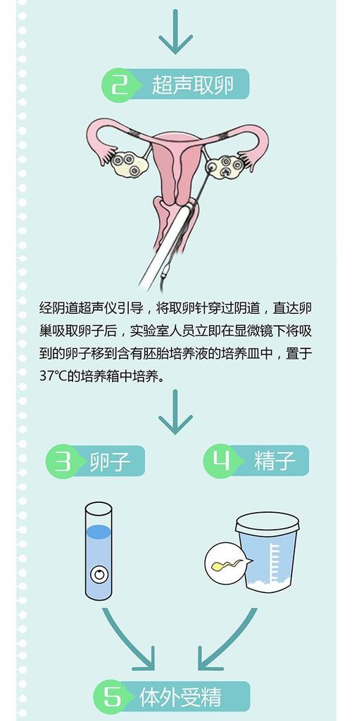 供精试管的全部流程_供精试管:从取卵到移植的全流程解析